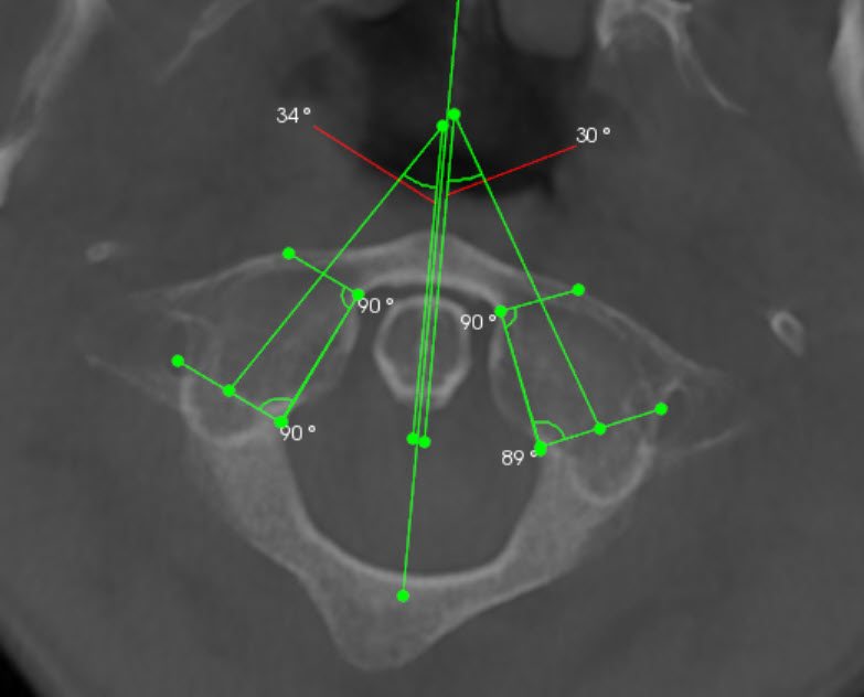 CBCT image of an atlas vertebra with its left and right joint angles measured at 34 and 30 degrees, showing asymmetry